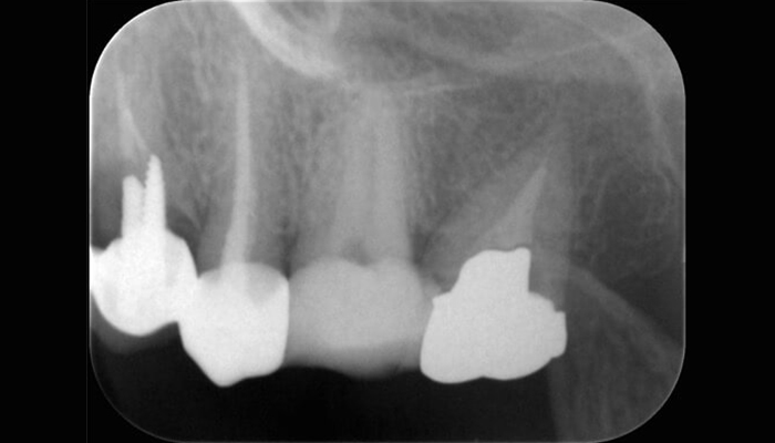 1. 根管が見つからないと、紹介を頂いた左上６のケースです一般的には上顎６番は３根が多いですが、エックス線検査で根があまり離開している様子がみられません。