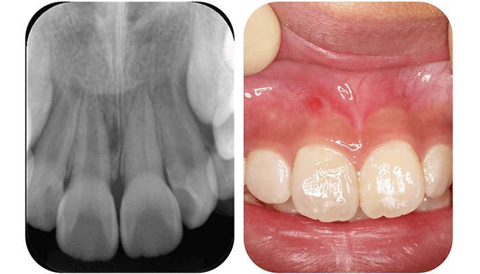 1. 以前にぶつけた歯の根の先が腫れてきたと来院されました。エックス線検査において、根の中腹に透過像があり、口腔内にも瘻孔の発現をみとめました。