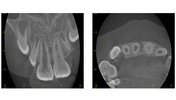 2. エックス線検査における透過像の出方が、歯根の水平破折を疑うためコーンビームCTで検査しました。