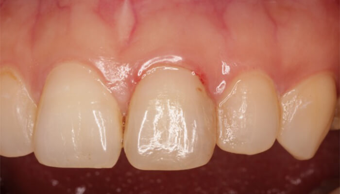 3. エックス線検査と、口腔内所見より、遠心隣接面に不適合の修復物があります。ここからの２次虫歯の進行により不可逆性歯髄炎に至ったのではないでしょうか。