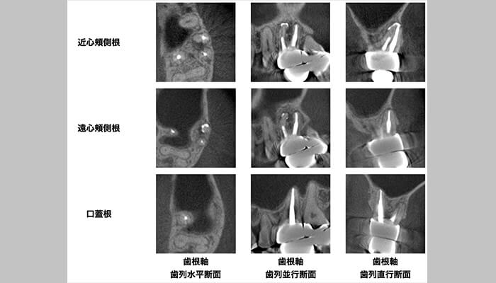 外科的根管治療での対応を希望