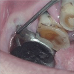 ② 歯周ポケットの深さを測る器具（ポケットプローブ）で、検査します。