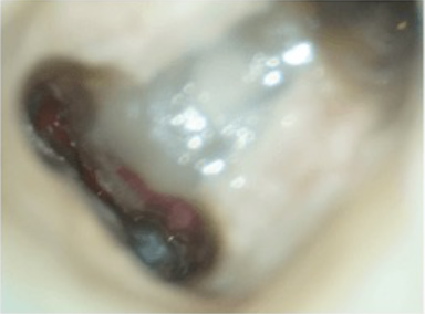 ① 患部は、下顎の第一大臼歯の前歯寄りにあります。