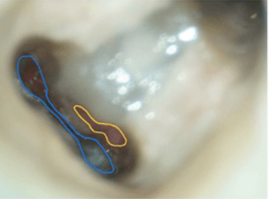 ② 歯の元々の根管は青で示したところですが、黄色で示したところに穿孔が確認できます。