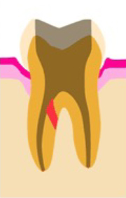 ③ イラストで図解すると、赤い部分が穿孔です。以前行った根管治療で歯根が削られ過ぎた状態です。
