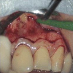 ① 患部周辺の歯肉を切り開いて、歯根の先端部にある病変を剥き出しにします。