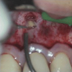 ② 炎症を起こしている歯周組織を取り除き、複雑な歯根端の病変を切除します。