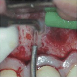 ③ 切った歯根端から差し込める形状のレトロチップという器具で、根管治療を行います。