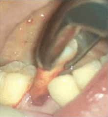 ② 歯周組織にダメージを与えないよう、慎重に抜歯します。